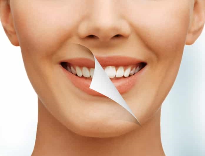 tandbleknings behandling med brilliant smile